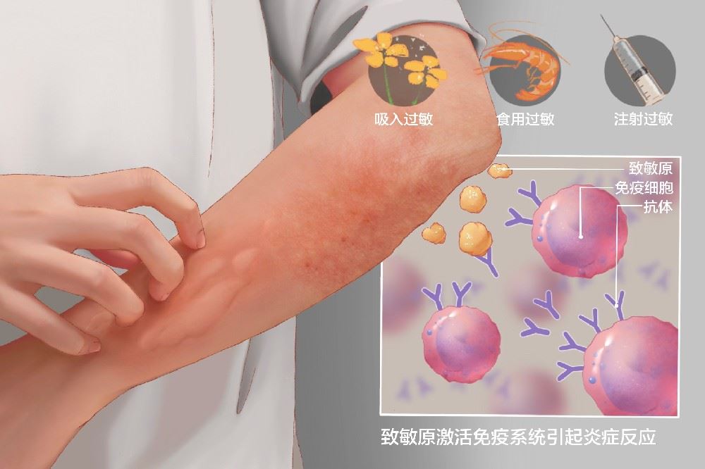 關于“過敏性皮炎”您知多少？